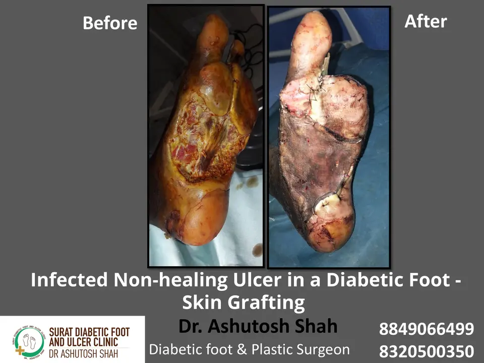 Diabetic Foot  PPT 3 checked by sir.pptx-5.webp